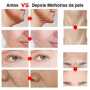 Ultrassom Facial HIFU Portátil Microfocado RejuveLift™